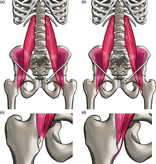 attachments of psoas, iliacus, pectineus,